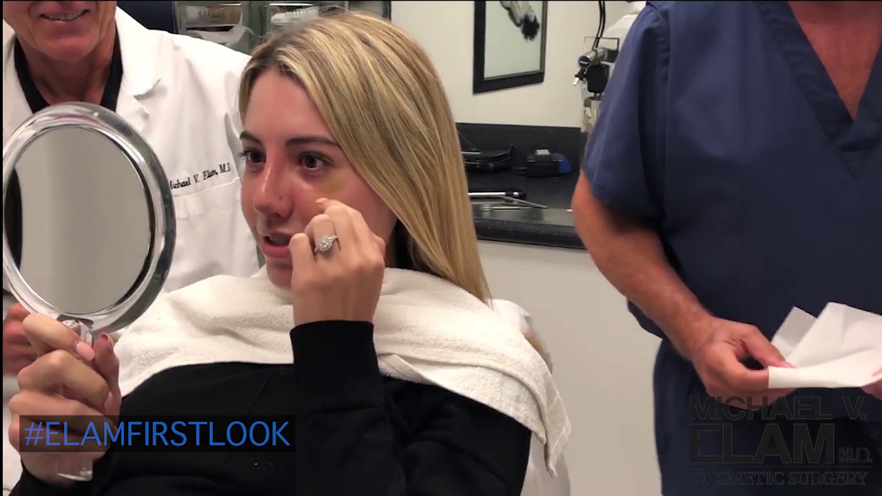 Rhinoplasty Reveal ft. 2 Weeks Post-op with Dr. Elam - 