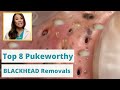 Dr. Pimple Poppers 8 WORST Blackhead Removals - You&#39;re not going to want to eat while you watch this