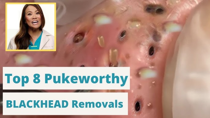 Dr. Pimple Poppers 8 WORST Blackhead Removals - You're not going