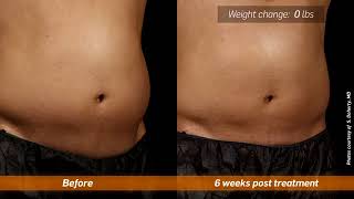 SculpSure - Electrik Image Spa -  How it works - Toledo, Detroit, Monroe