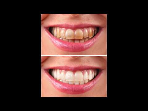 internes Bleaching