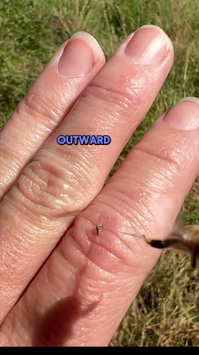 Bee stings hurt!