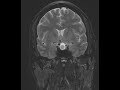 Pituitary Apoplexy 