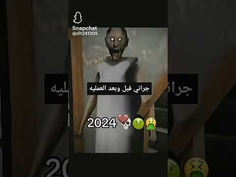 تراني قبل بعد