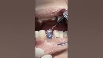 Rebuild tooth with fiber post and composite restoration after root canal treatment #dentist