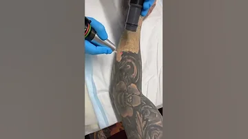 SUSLASER Picolaser Tattoo Removal Whole Arm Tattoo Removal With Less Chance Of Forming Bubbles 