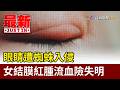 眼睛遭蜘蛛入侵 女結膜紅腫流血險失明【最新快訊】