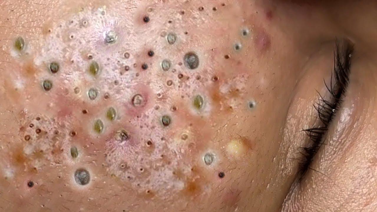 𝑹𝒆𝒎𝒐𝒗𝒊𝒏𝒈 𝑯𝒊𝒅𝒅𝒆𝒏 𝑫𝒊𝒓𝒕 𝑭𝒓𝒐𝒎 𝑷𝒐𝒓𝒆𝒔 | 𝑺𝒐𝒐𝒕𝒉𝒊𝒏𝒈 & 𝑺𝒂𝒕𝒊𝒔𝒇𝒚𝒊𝒏𝒈 