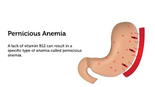 مناعة نظري م6 جزء اول من المنهج الوزاري لقسم التحليلات المرضية المرحلة الرابعة Pernicious Anemia