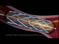 3d angioplasty stent heart surgery medical 3d animation company san antonio