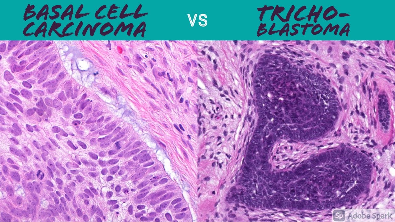 Hair Follicle Tumors vs Basal Cell Carcinoma Made Simple 5Minute