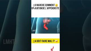 Ça Marche Comment Opération De Lappendice ?