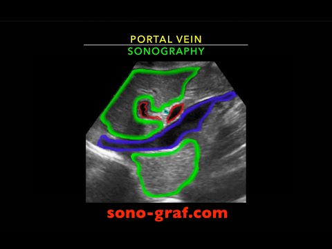 Sonography - Portal vein