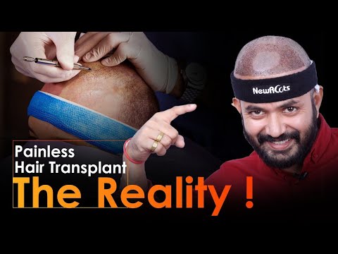क्या HAIR TRANSPLANT में दर्द होता है? | Is Hair Transplant Painful? | Explained in Hindi