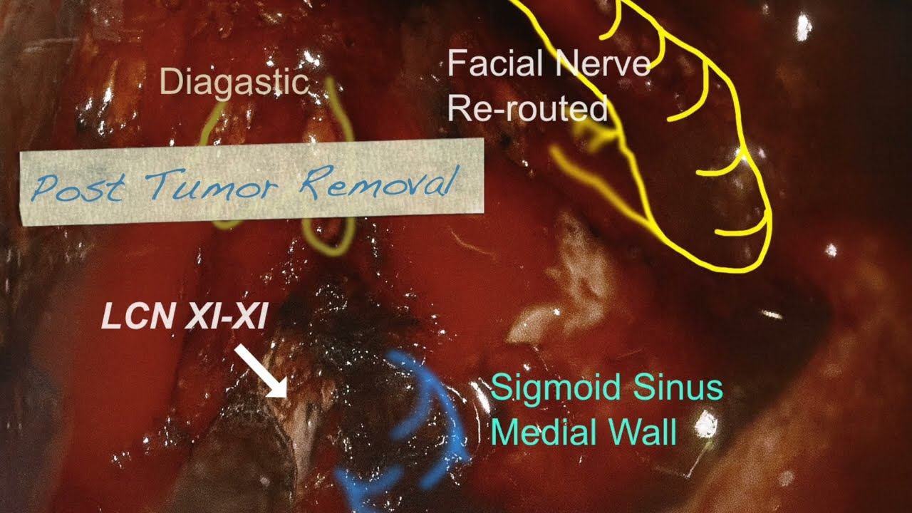 Cranial Nerve Monitoring with Rivarp NervENT IONM | Head and Neck Surgery Amrita