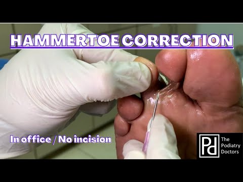 Video: Ar į plaktuko piršto remontą įtraukta lenkimo tenotomija?