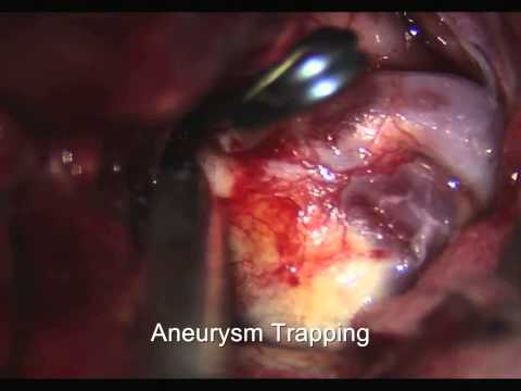 Direct suction decompression and fenestrated clip reconstruction of complex paraclinoid CA aneurysm