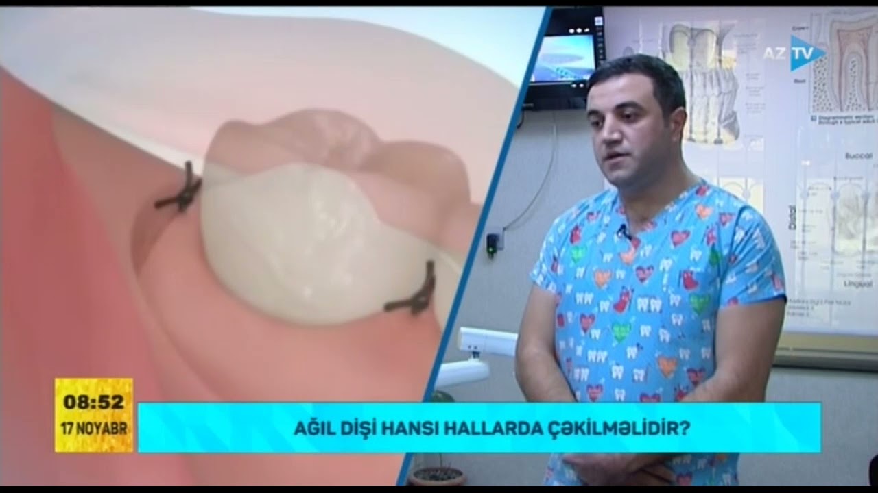 Ağıl dişi hansı hallarda çəkilməlidir?