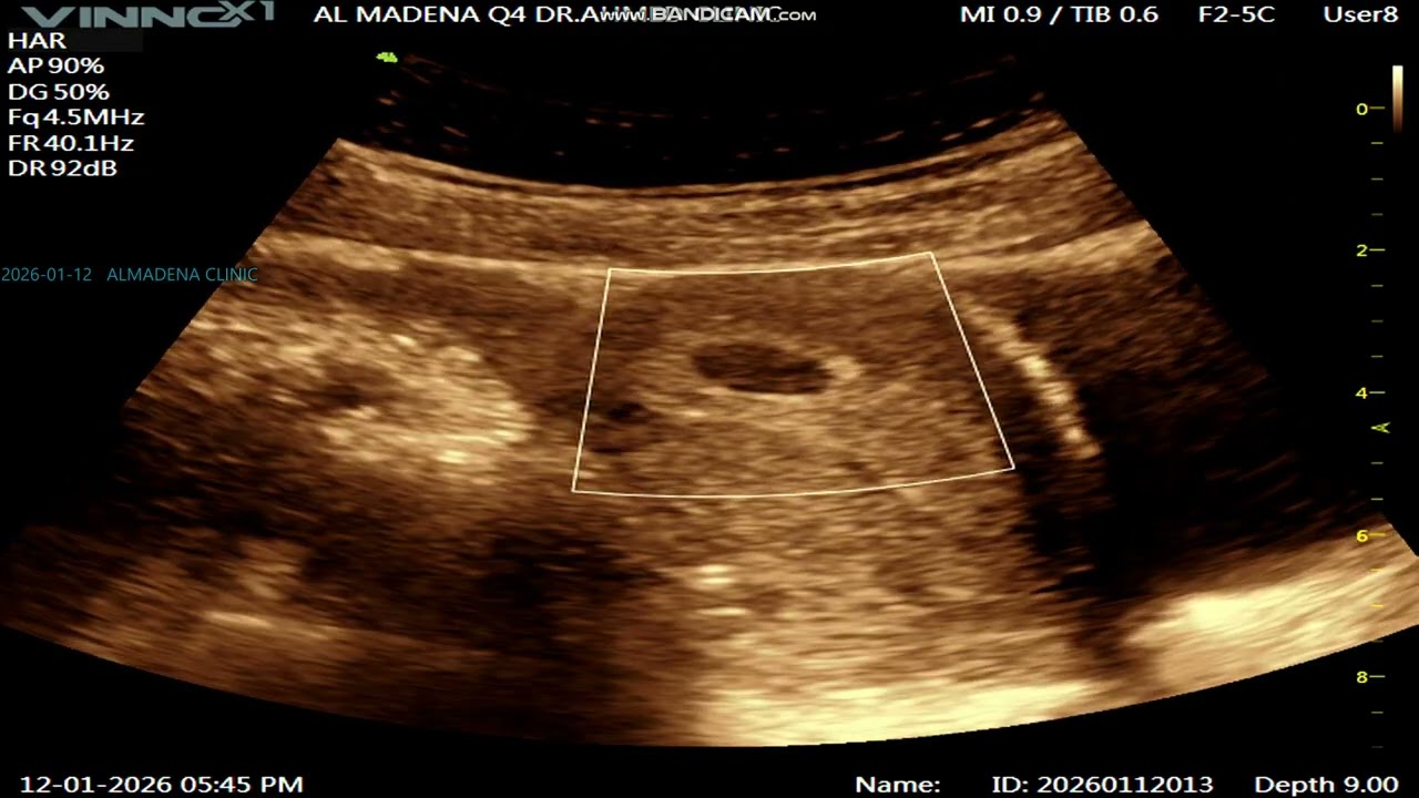 OBST 1 : 4W4D gestational  sac   2026 01 12 17 38