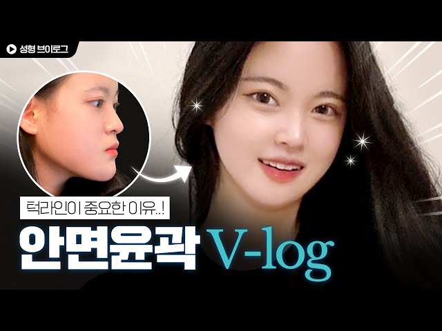 턱부자의 예뻐진 후기✨ 성형 브이로그 2탄 | 수술후 | 티에스성형외과