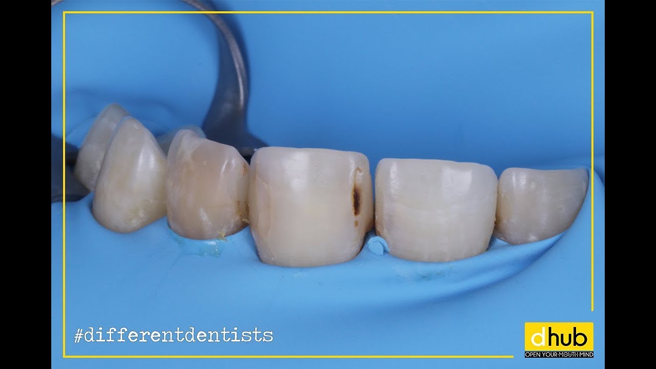 LA CAT TIMP AR TREBUI SCHIMBATE PLOMBELE SI DE CE / Dentistry Hub