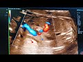 Portal Vein Aneurysm #ultrasound#early diagnosis#portal
