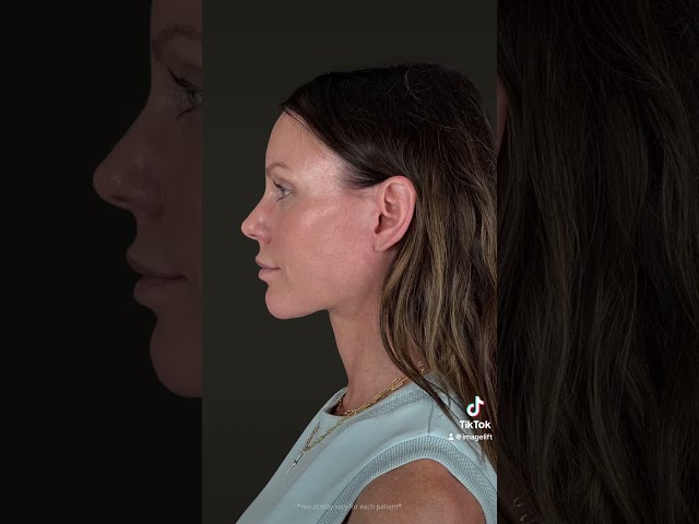 🔥 𝐄𝐀𝐑𝐋𝐘 𝐓𝐑𝐄𝐀𝐓𝐌𝐄𝐍𝐓. 𝐒𝐍𝐀𝐓𝐂𝐇𝐄𝐃 𝐑𝐄𝐒𝐔𝐋𝐓𝐒. 🔥