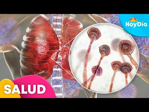 Una doctora explica qué es la aspergilosis pulmonar, cómo se contrae y cuáles son sus riesgos