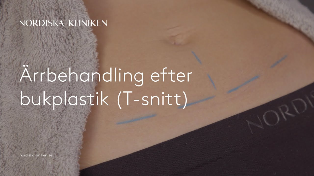 Ärrbehandling efter bukplastik med T-snitt