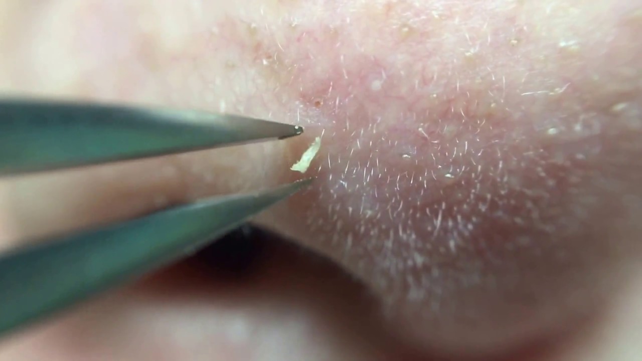 鼻角栓100 nose blackheads★Tweezers only★ YouTube