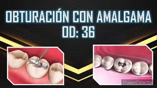 Obturación Con Amalgama 🦷 (CEUMH) 💙💚