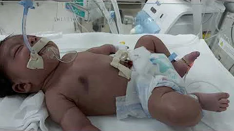 Case 285 neonatal seizures due to perinatal asphyxia, HYpoxic ischemic encephalopathy