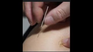 What Is De Qi For Clinical Success Why Do I Need To Learn How To Obtain The Qi On My Patients?