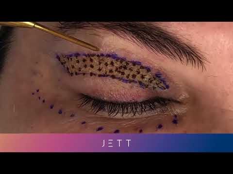 Jett Plasma - Blefaroplastia