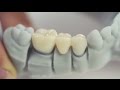 3D Printing in the Dental Laboratory: fabrication of temporary crowns & bridges with Freeprint® temp