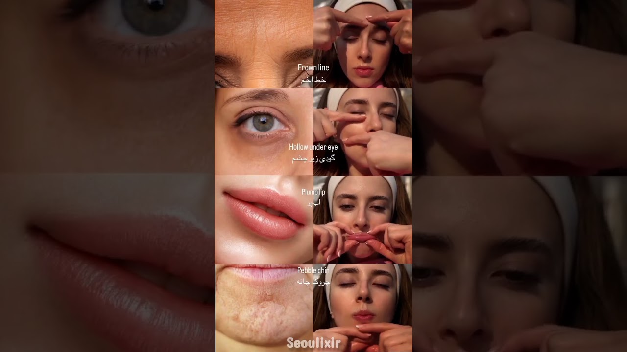 Frown line, plump lips, hollow under eye, pebble chin 