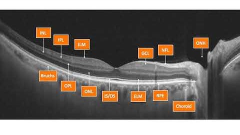 Optovue OCT Interpretation Session 1 OCT Introduction to SD OCT