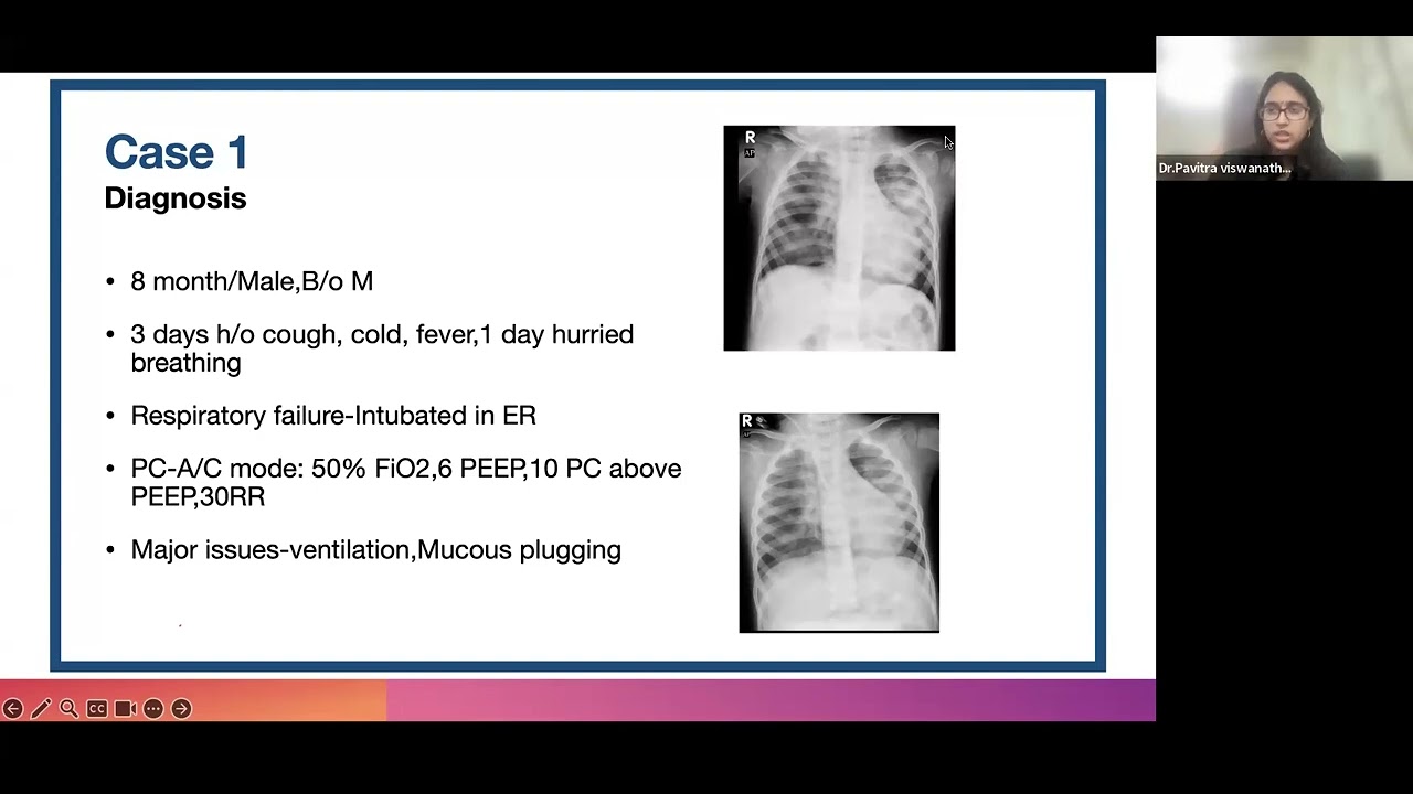 Liberation from Mechanical Ventilation-Step by step guide by Dr Pavitra