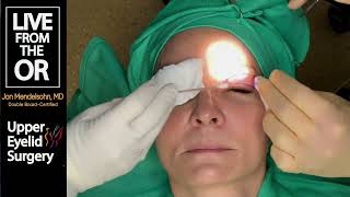 LIVE Upper Blepharoplasty Actual Surgery of an Upper Eyelid Lift 2023