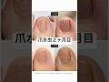 【２ヶ月目】爪水虫&グリーンネイル🦶一番多かった疑問を先生に聞いてみたよ👨‍⚕️ #白癬菌 #緑膿菌 #セルフネイル #ジェルネイル #爪水虫 #グリーンネイル #フットネイル