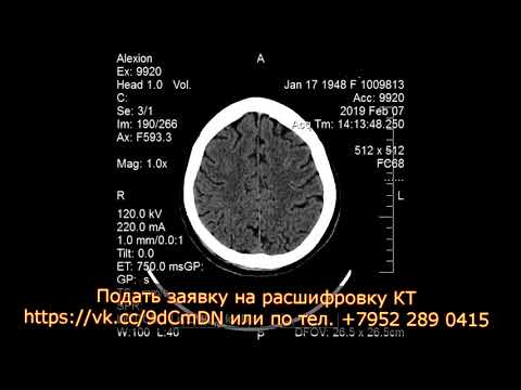 Подкожная гематома мягких тканей затылочной области на КТ головного мозга расшифровке