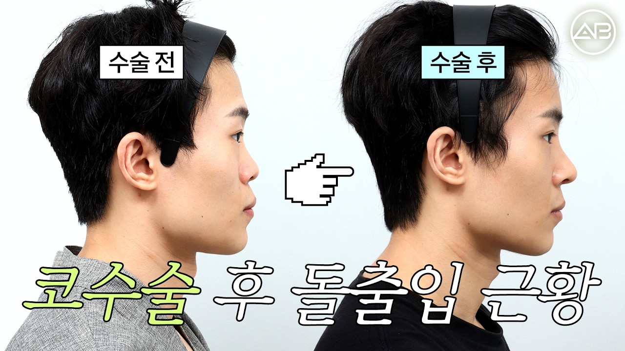 남자 코수술 한 달 후, 돌출입이 정말 들어가 보일까? | 에이비성형외과