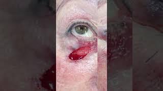Early Detection Of Skin Cancers Is Key. Dont Delay