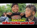 Bocah kocak  mata hitam akibat korban patah hati