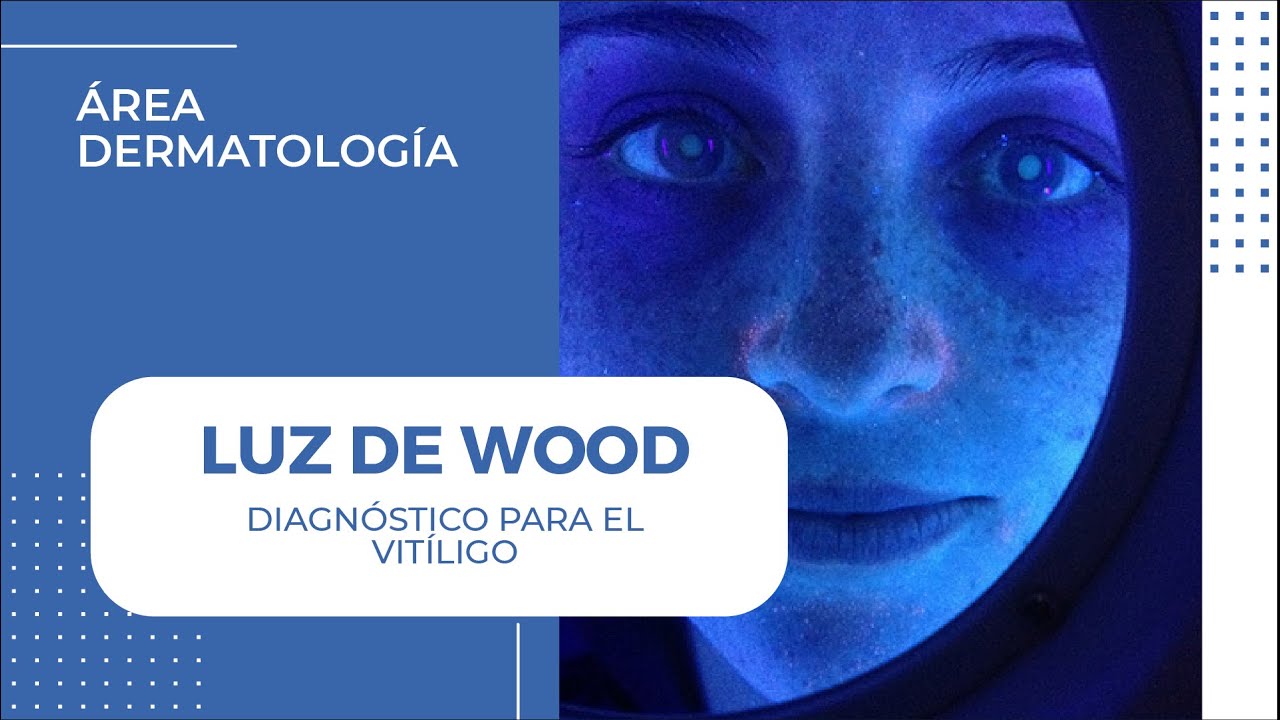 Diagnóstico de VITÍLIGO con Luz de Wood - Dermaperú 