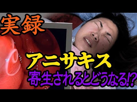 アニサキス4匹に寄生された女の胃の中の映像がこちらです(笑)