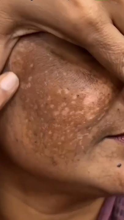 Download lagu Remove Pigmentation & Darkspots Naturally | Easy Tomato Facial Scrub At Home #darkspots #ytshorts