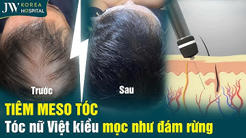 TIÊM MESO TÓC tại Bệnh viện JW, nữ Việt kiều thoát cảnh RỤNG TÓC, HÓI ĐẦU sau 10 năm tự ti