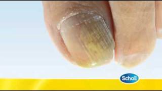 Fungal Nail Condition by Scholl