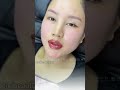 Lips Filler Vietnam